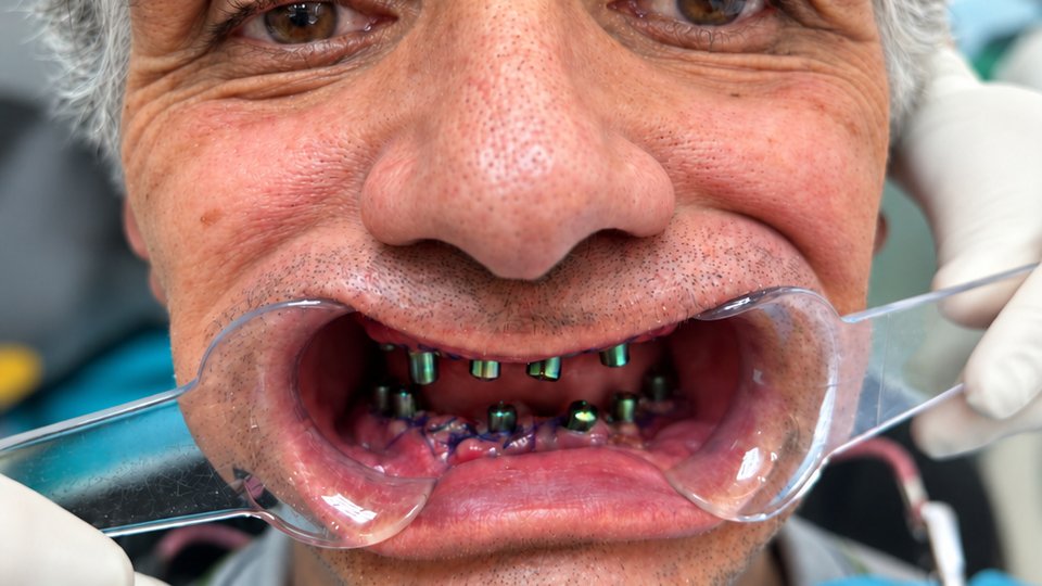 Before: Full-arch dental implants