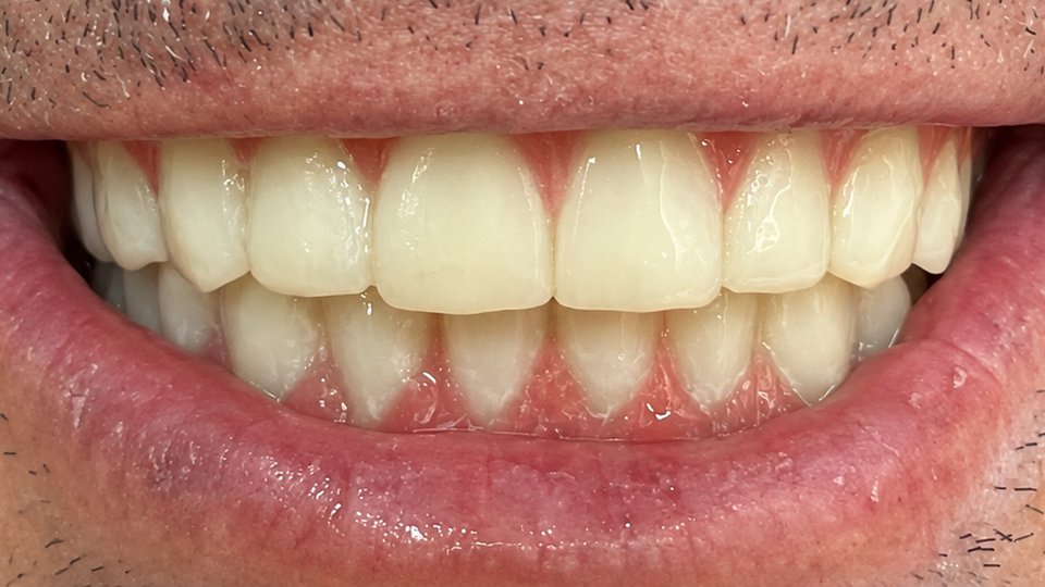 After: Full-mouth rehabilitation