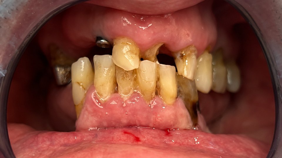 Before: Full-mouth rehabilitation