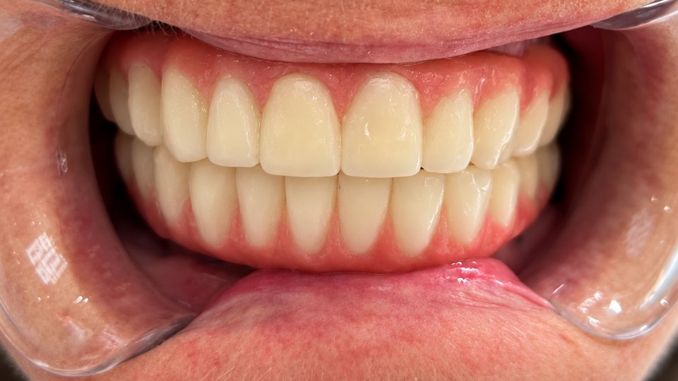 After: Full-mouth restoration