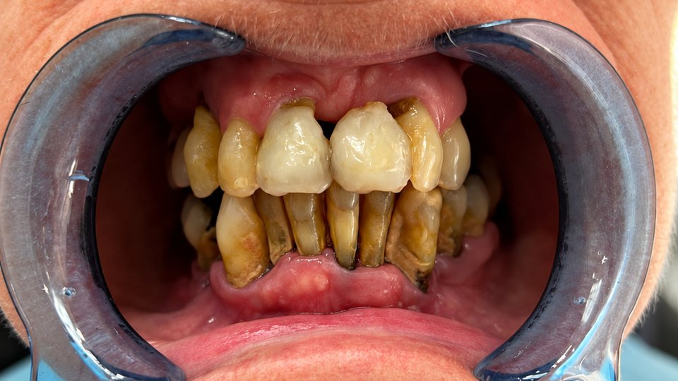 Before: Full-mouth restoration