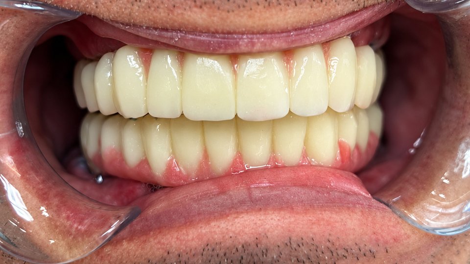 After: Complete smile restoration