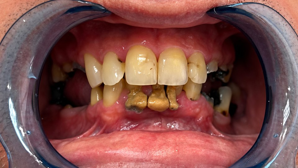 Before: Complete smile restoration