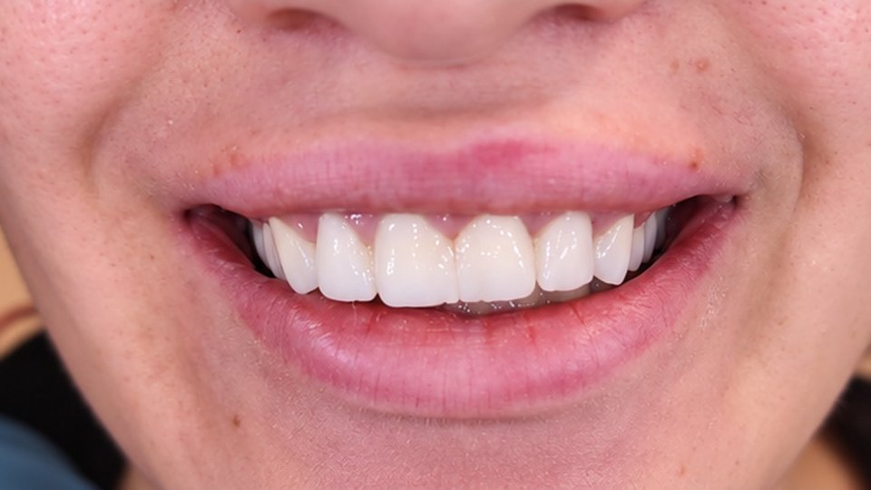 After: Complete smile makeover