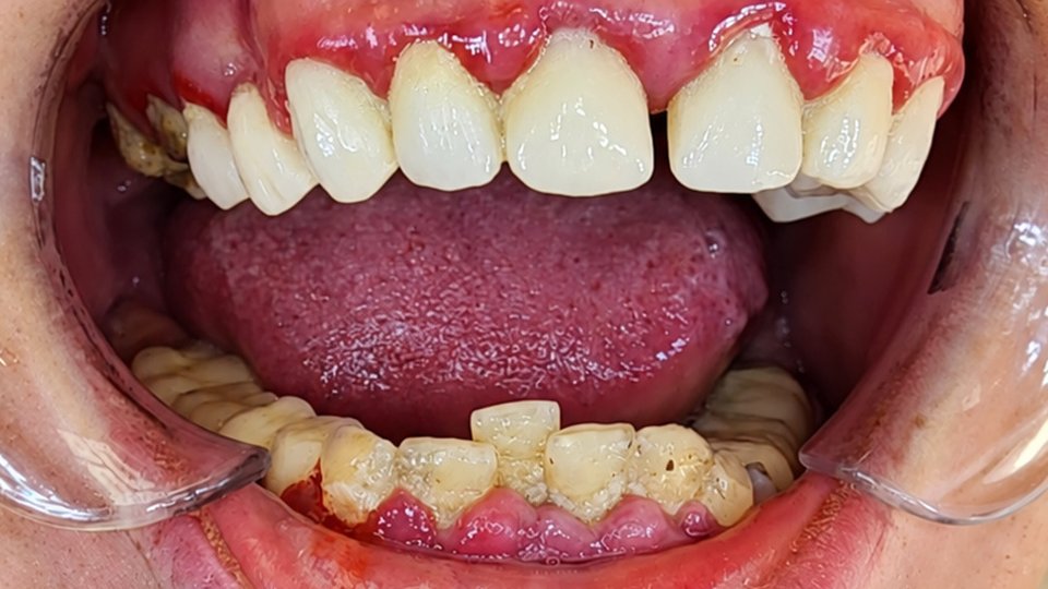 Before: Complete smile makeover