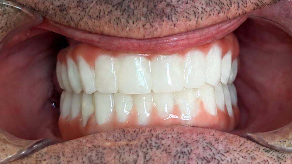 After: Orthodontic treatment