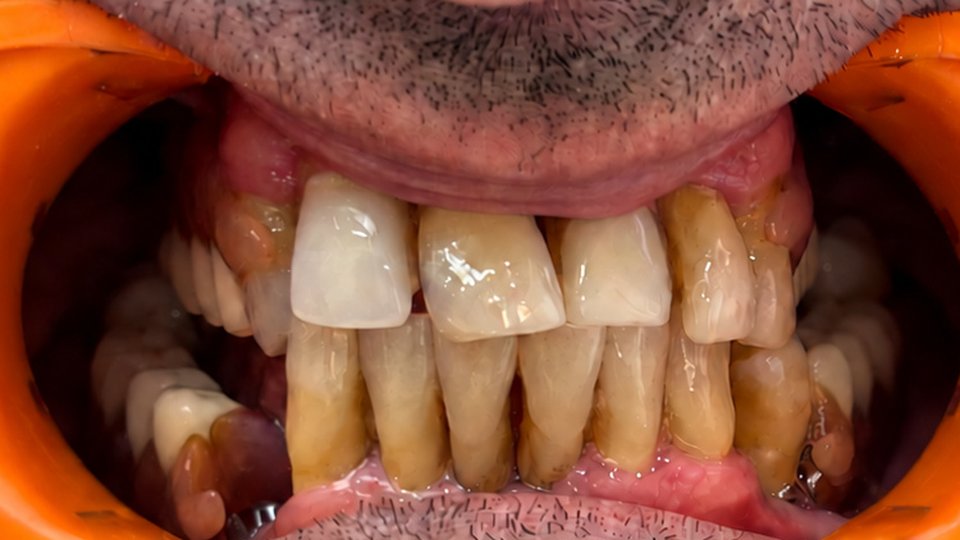 Before: Orthodontic treatment